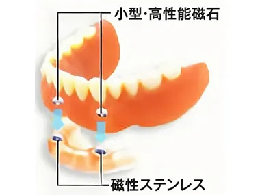 マグネットデンチャーの仕組み。入れ歯の磁石と、歯根に埋め込まれた磁性金属が引き合う。