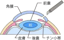 白内障手術の角膜切開